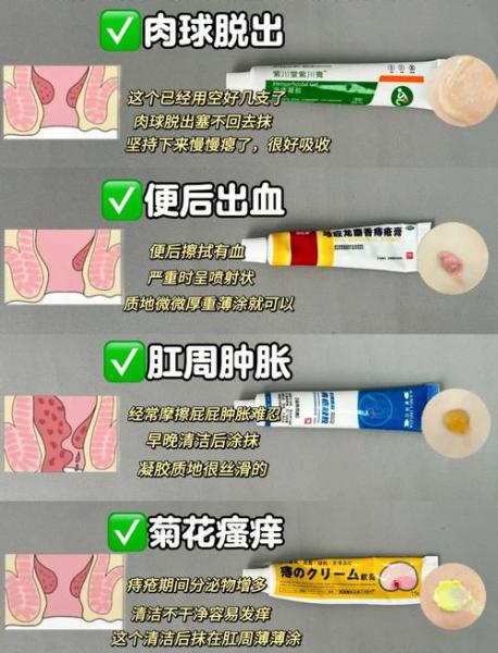 痔疮膏的正确使用方法-第1张图片 痔疮膏的正确使用方法-第1张图片